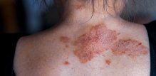 Život sa psorijazom često je izazovan
