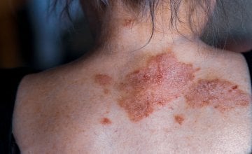 Život sa psorijazom često je izazovan