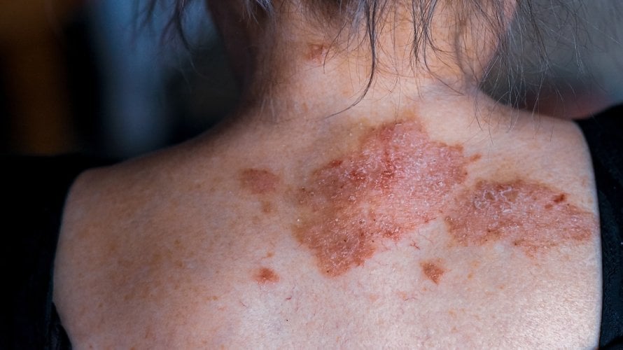 Život sa psorijazom često je izazovan