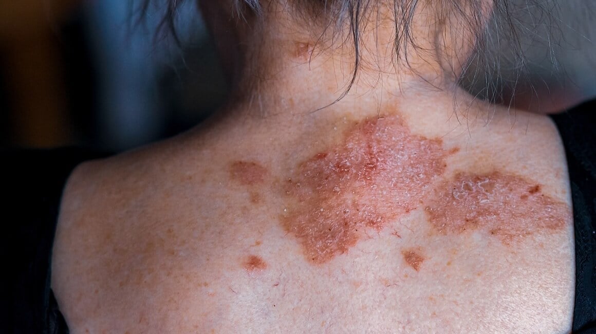 Život sa psorijazom često je izazovan