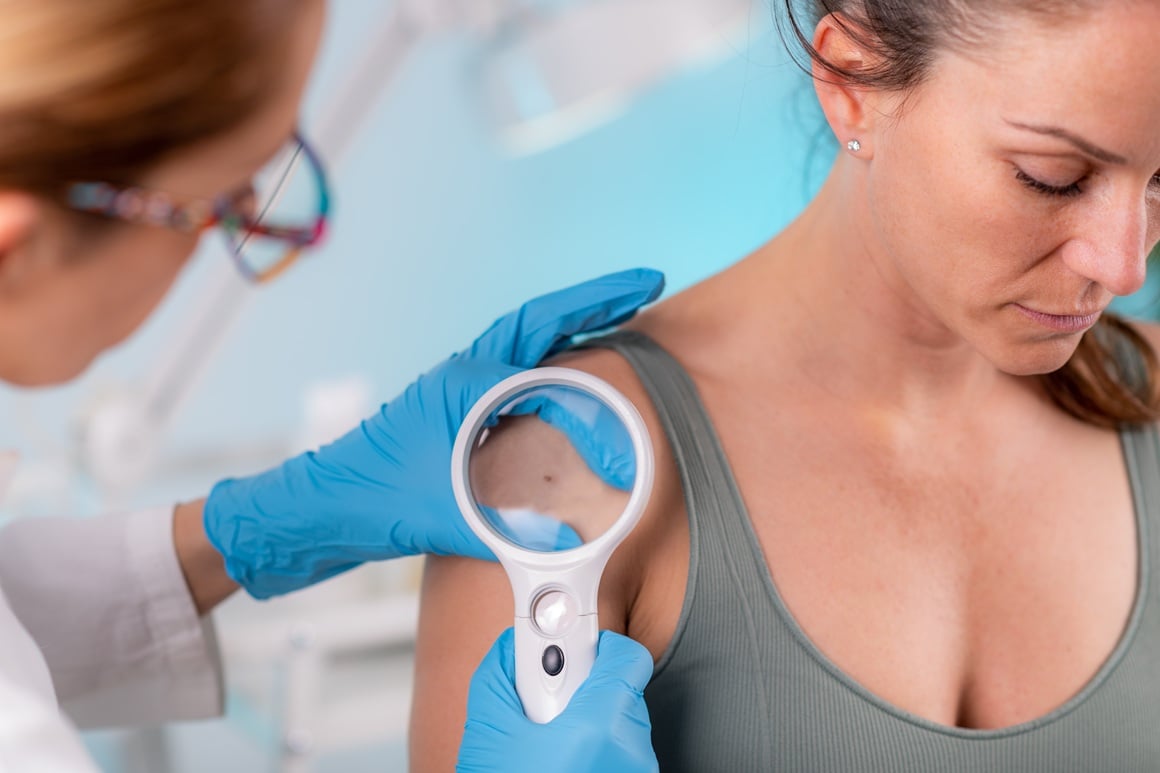 bazocelularni karcinom