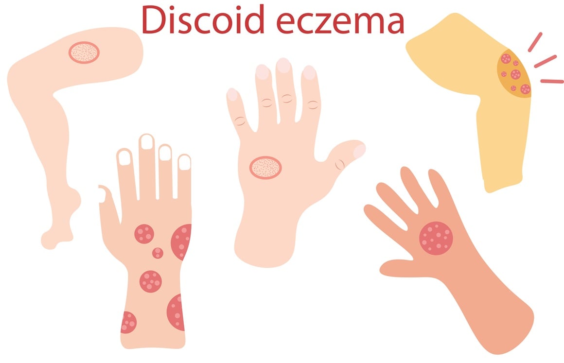 diskoidni ekcem