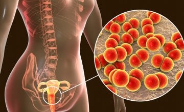 gonoreja svake godine pogađa više od 80 milijuna ljudi diljem svijeta