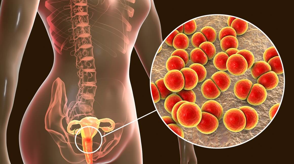 gonoreja svake godine pogađa više od 80 milijuna ljudi diljem svijeta