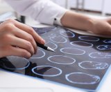 lipoična kiselina je pokazala potencijal u usporavanju gubitka moždanog tkiva