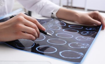 lipoična kiselina je pokazala potencijal u usporavanju gubitka moždanog tkiva