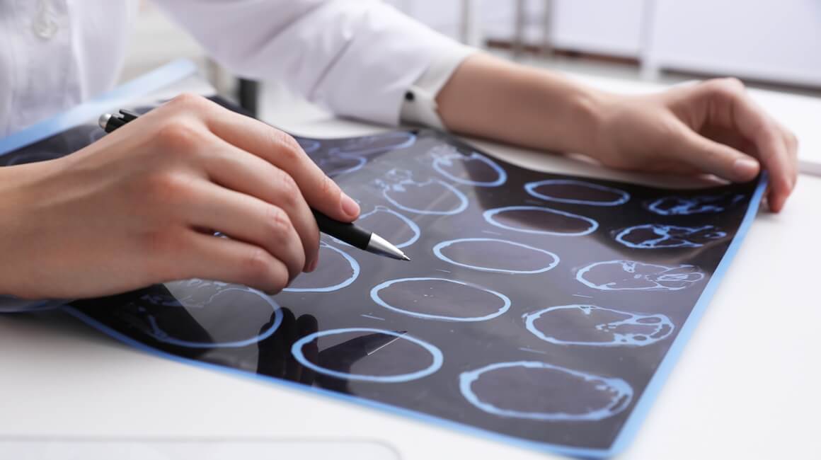 lipoična kiselina je pokazala potencijal u usporavanju gubitka moždanog tkiva