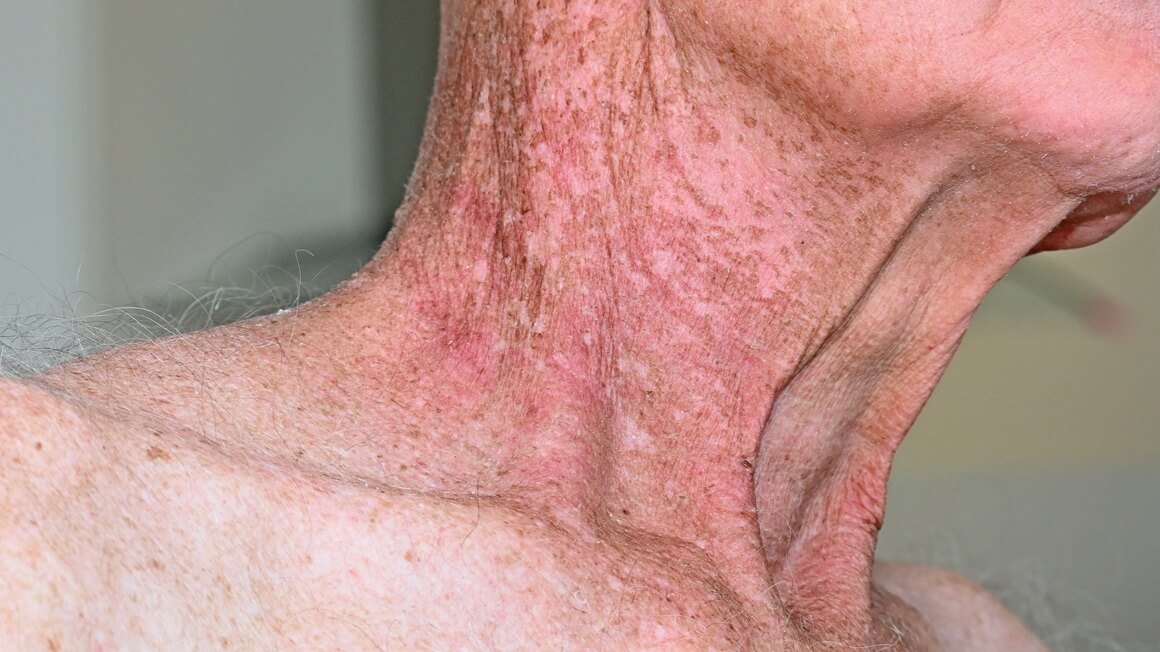 nuspojave terapije zračenjem