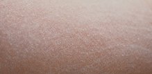 Ekstremno suha koža zimi, u medicini poznata i kao xerosis cutis, rijetko dolazi tiho