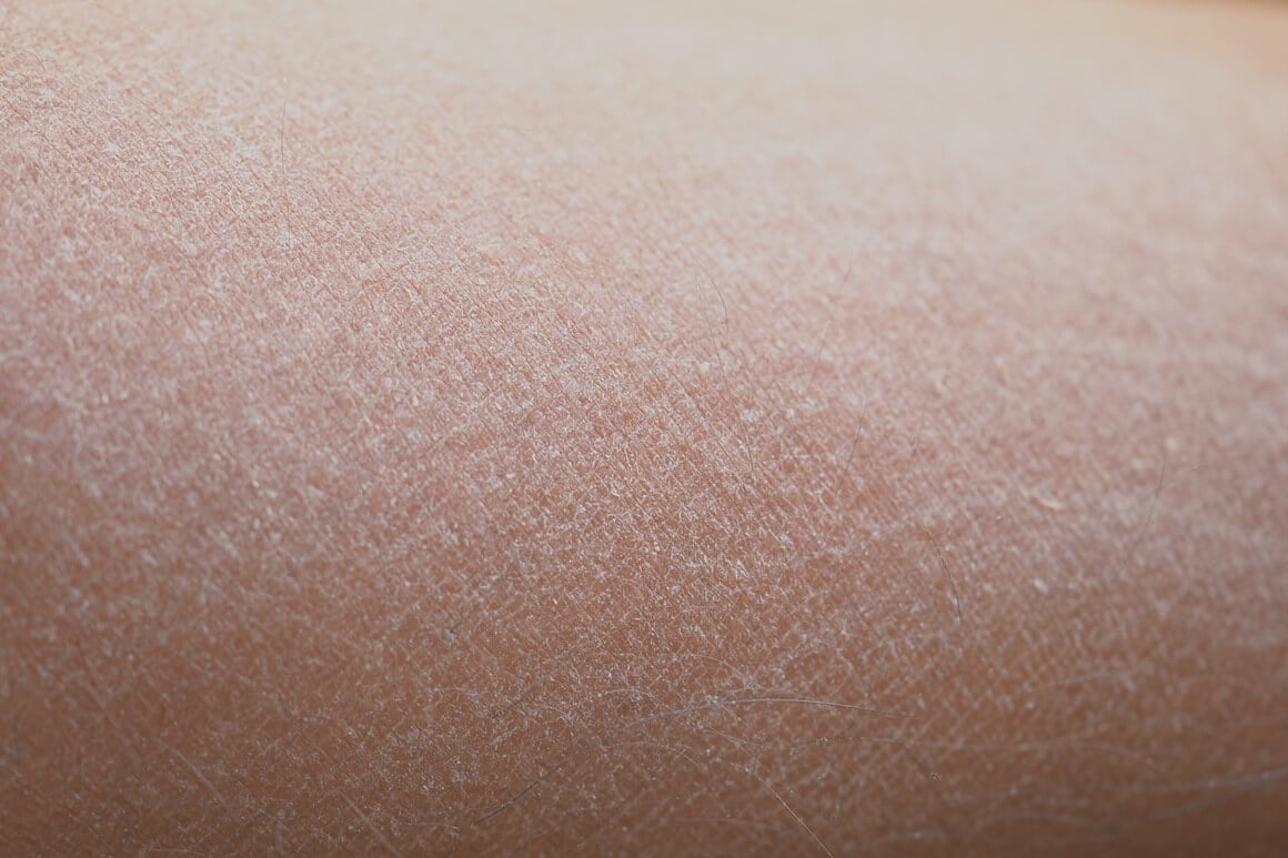 Ekstremno suha koža zimi, u medicini poznata i kao xerosis cutis, rijetko dolazi tiho