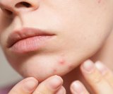 Imate zatvor i prištiće Evo što vam koža možda pokušava poručiti