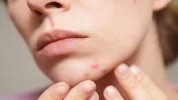 Imate zatvor i prištiće Evo što vam koža možda pokušava poručiti