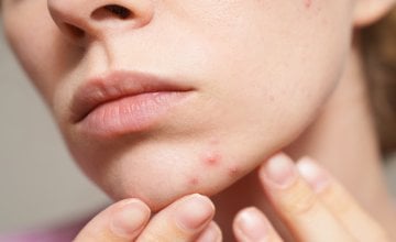 Imate zatvor i prištiće Evo što vam koža možda pokušava poručiti