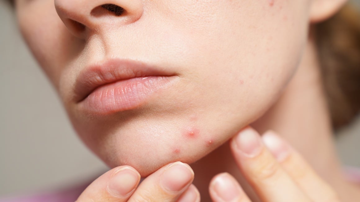 Imate zatvor i prištiće Evo što vam koža možda pokušava poručiti