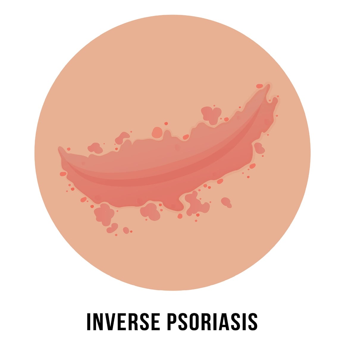 Inverzna psorijaza - simptomi