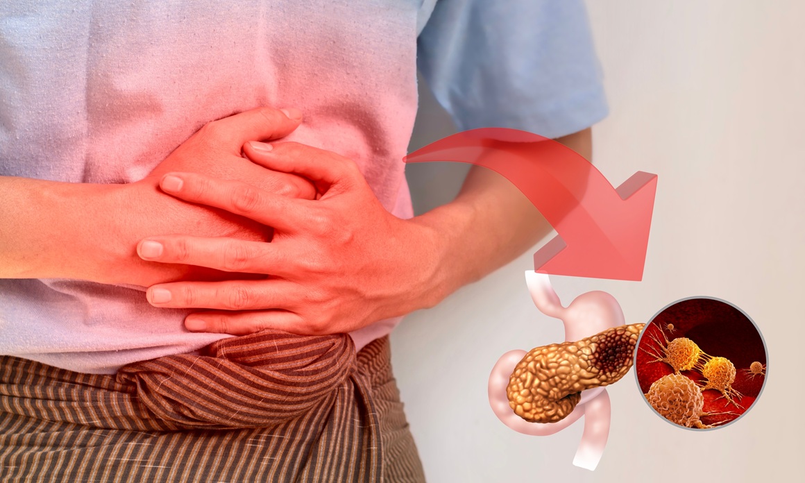 Jedan od najvećih izazova u liječenju raka gušterače jest razvoj otpornosti tumora na terapiju