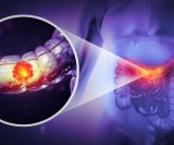 Kod osoba koje dugotrajno i kontinuirano piju velike količine alkohola rizik od raka debelog crijeva čak je 91 % veći