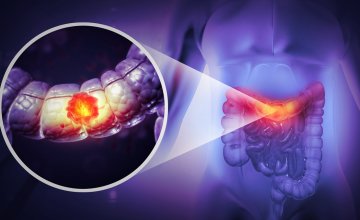 Kod osoba koje dugotrajno i kontinuirano piju velike količine alkohola rizik od raka debelog crijeva čak je 91 % veći