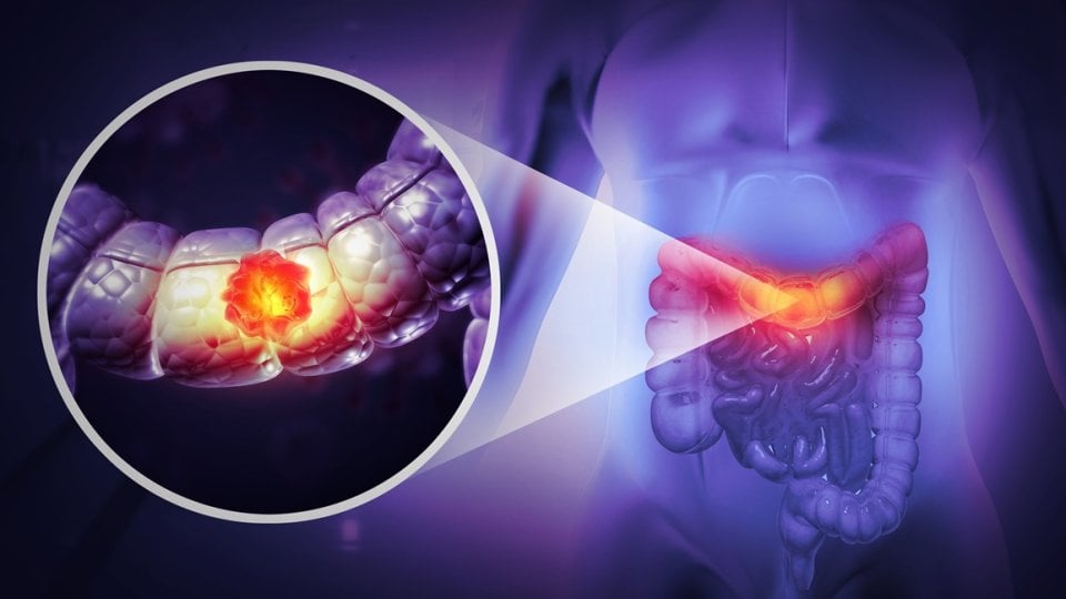 Kod osoba koje dugotrajno i kontinuirano piju velike količine alkohola rizik od raka debelog crijeva čak je 91 % veći
