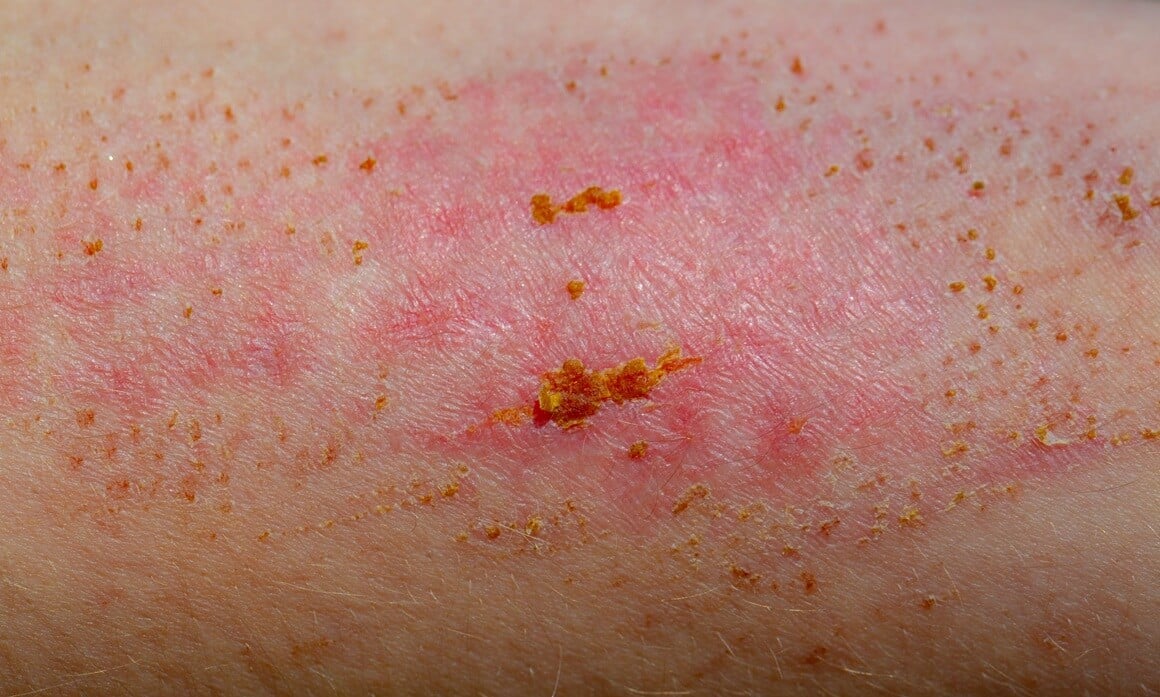 Koebnerov fenomen označava pojavu novih kožnih promjena na mjestima mehaničke, kemijske ili upalne ozljede kože