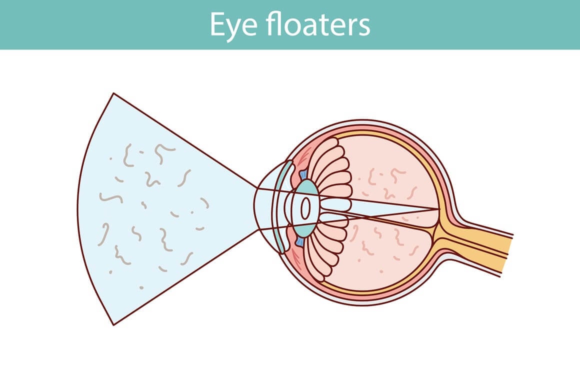 Mušice u oku - liječenje
