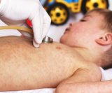 Ospice su izuzetno zarazna virusna bolest