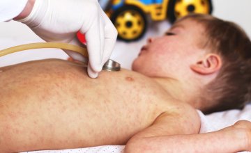 Ospice su izuzetno zarazna virusna bolest