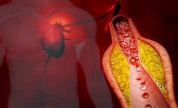 Plak su masne naslage koje se nakupljaju na stijenkama arterija