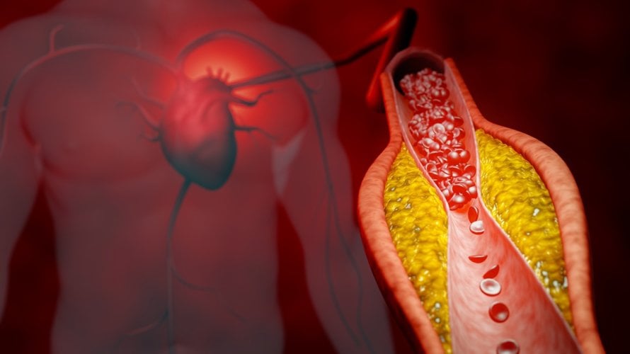 Plak su masne naslage koje se nakupljaju na stijenkama arterija