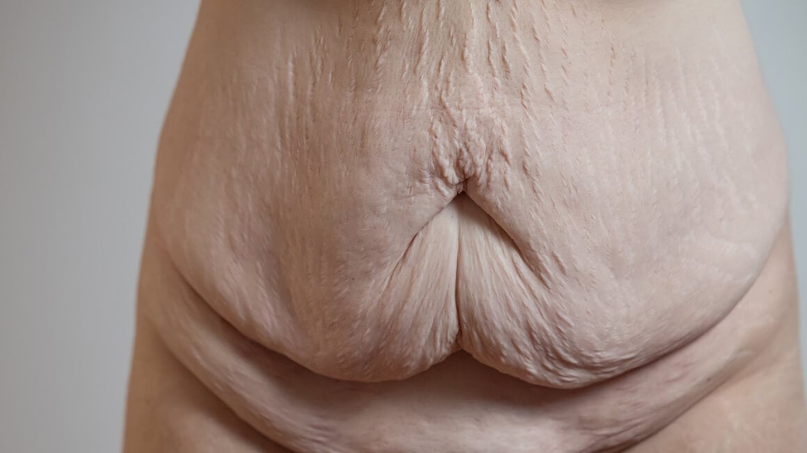 Prirodno zatezanje kože tijela