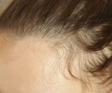 Stručnjaci ističu da je kod ispadanja kose ključno unositi nutrijente koji služe kao građevni materijal za kosu i pomažu u njezinoj zaštiti