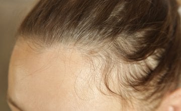 Stručnjaci ističu da je kod ispadanja kose ključno unositi nutrijente koji služe kao građevni materijal za kosu i pomažu u njezinoj zaštiti