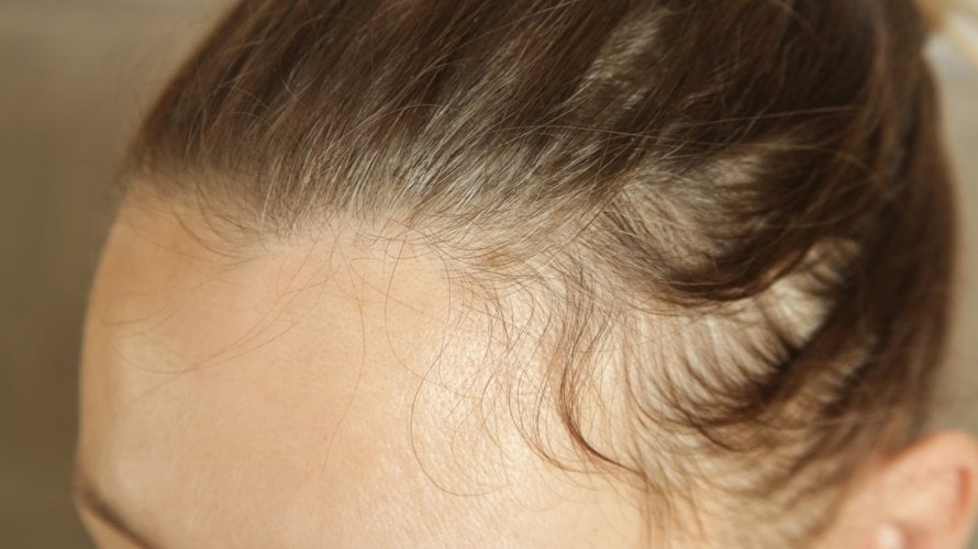 Stručnjaci ističu da je kod ispadanja kose ključno unositi nutrijente koji služe kao građevni materijal za kosu i pomažu u njezinoj zaštiti