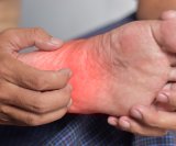 Svrbež ruku i stopala