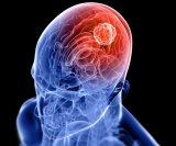 Vrste tumora na mozgu