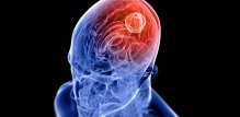 Vrste tumora na mozgu