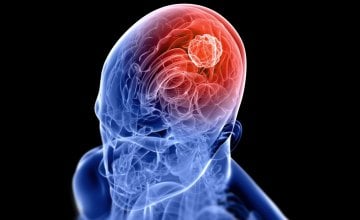 Vrste tumora na mozgu