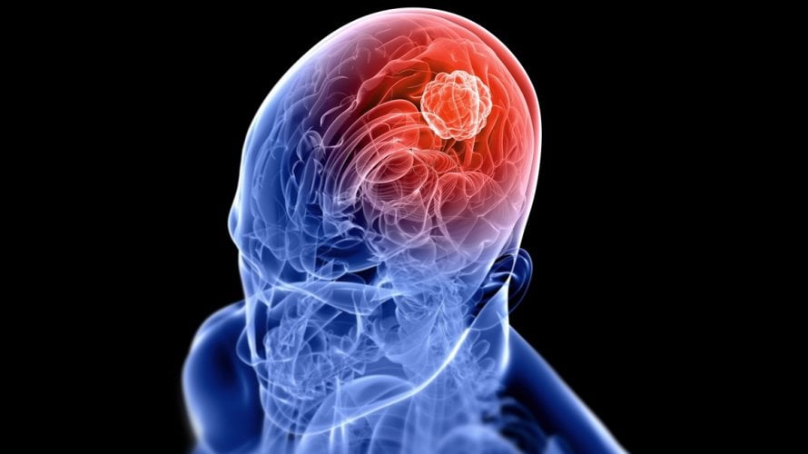 Vrste tumora na mozgu