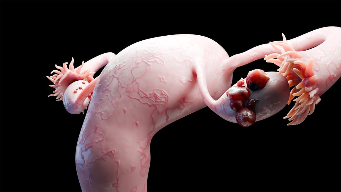 Životni rizik za razvoj raka jajnika kod žena bez visokorizične mutacije manji je od 2 posto