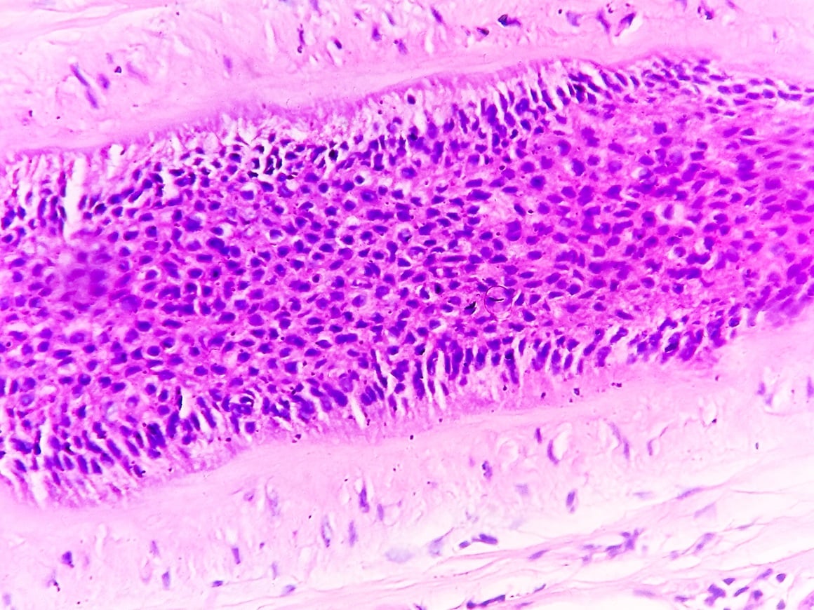 karcinom in situ pod mikroskopom