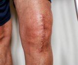 kratkotrajna primjena lijeka semaglutida prije operacije koljena može znatno smanjiti rizik od komplikacija kod dijabetičara