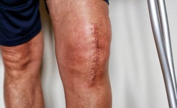 kratkotrajna primjena lijeka semaglutida prije operacije koljena može znatno smanjiti rizik od komplikacija kod dijabetičara