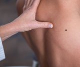 osobe koje su uzimale nikotinamid - oblik vitamina B3 - imale su značajno manji rizik od razvoja novih kožnih tumora