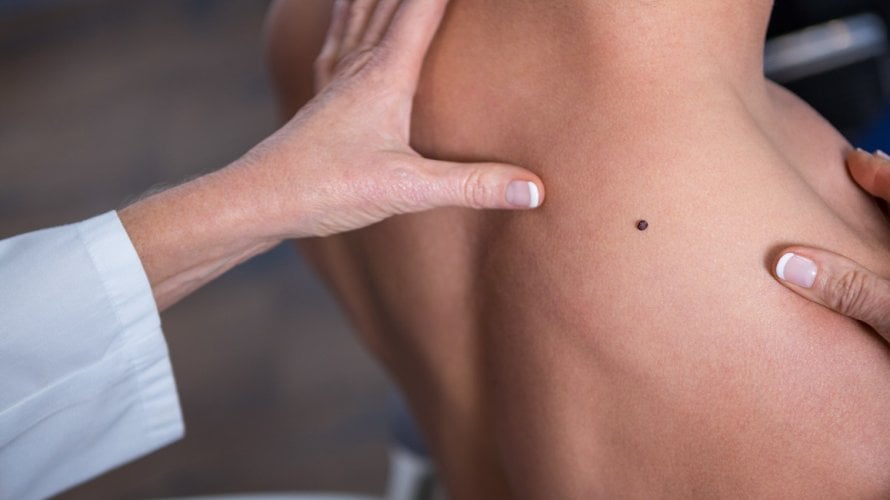 osobe koje su uzimale nikotinamid - oblik vitamina B3 - imale su značajno manji rizik od razvoja novih kožnih tumora