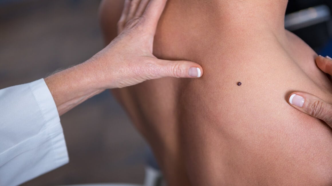 osobe koje su uzimale nikotinamid - oblik vitamina B3 - imale su značajno manji rizik od razvoja novih kožnih tumora