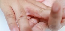 svrbež stopala i dlanova