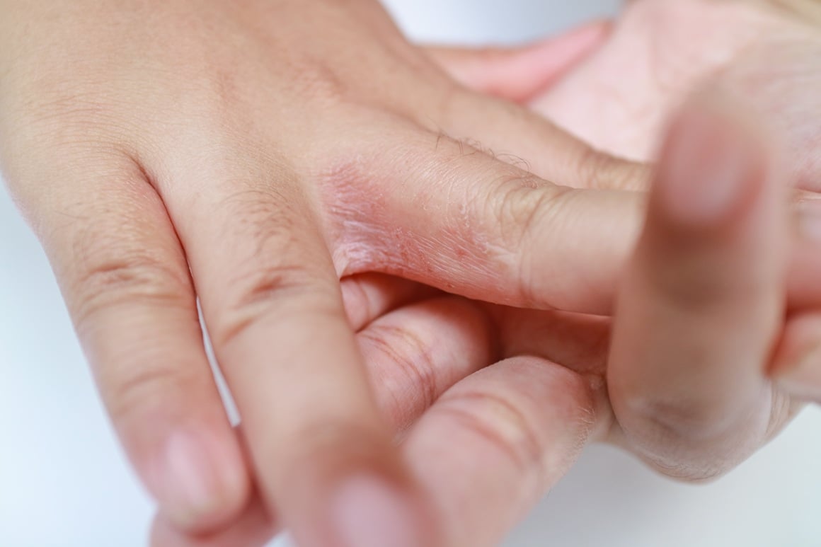 svrbež stopala i dlanova