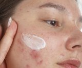 Akne kod tinejdžera