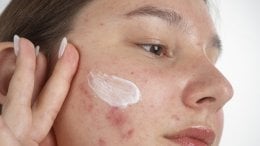 Akne kod tinejdžera