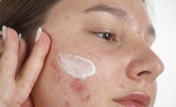 Akne kod tinejdžera